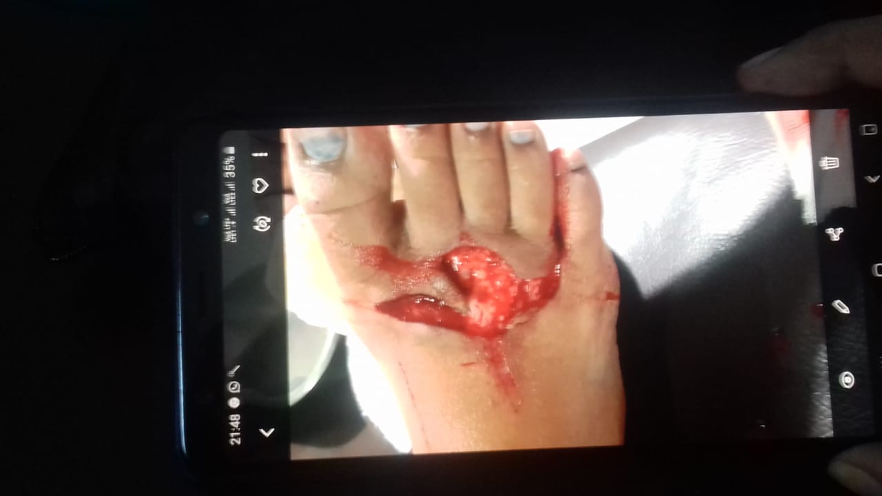 ए सी सी की लापरवाही से बालिका हुई घायल: पैर मे लगे 50 टांके